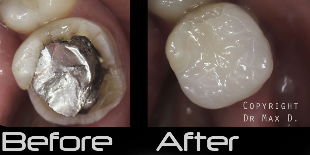 broken filling before after